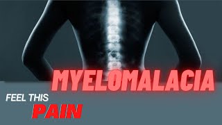 Feel This Pain S3E3 Myelomalacia [upl. by Auqinal]