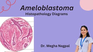 Ameloblastoma  Histopathology  Easiest Diagrams  Oral Pathology BDS [upl. by Egiedan190]