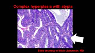 Topic 54 Endometrial Hyperplasia and Carcinoma [upl. by Pontias822]