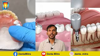 ಹಲ್ಲು ಕಟುವುದು prosthodontic implantdenture removabledenture dentalbridge [upl. by Acinnor500]