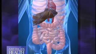 What is Diverticulitis Video [upl. by Penni50]