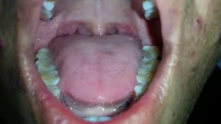 Tongue Fasciculation in MND [upl. by Syverson]