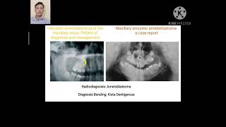 Journal Reading  Maxillary Unicystic Ameloblastoma Alfa Sinaga 04074881719028 [upl. by Ttehr]