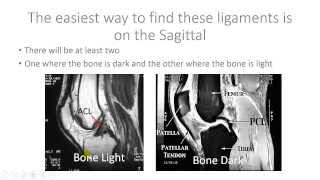 Read Knee MRI ACL and PCL  Help with Reading MRI [upl. by Ennaeiluj822]