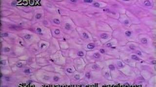 Basic Medical Pathology Neoplasis I [upl. by Attennod]