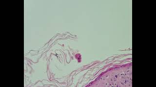 Histopathology of Lupus erythematosus [upl. by Asta]