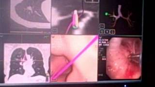 Lung Nodule Diagnosis using Electromagnetic Navigational Bronchoscopy ENB [upl. by Rabi]