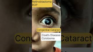 LEUCOCORIA  White pupillary reflex ophthalmology neetpg mnemonics exam online leukocoria [upl. by Mord65]