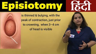 Episiotomy in Hindi  Perineotomy  Nursing Lecture [upl. by Stegman]