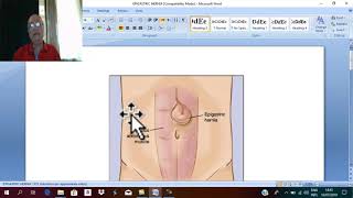 Hernia in English 21  Divarication of the recti   by Dr Wahdan [upl. by Elvyn327]