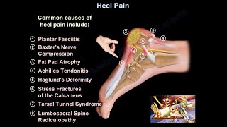 Heel Pain causes and treatment plantar fasciitis diagnosis and treatment [upl. by Eceeryt]