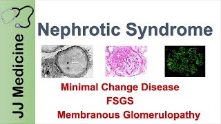 Acute PostStreptococcal Glomerulonephritis APSGN Nephritic Syndrome Kidney PathologyNephrology [upl. by Ajdan448]