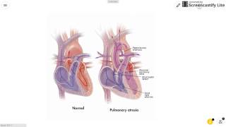 Pulmonary Atresia [upl. by Riggall]