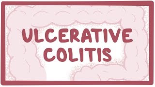 Ulcerative colitis  causes symptoms diagnosis treatment pathology [upl. by Keane]