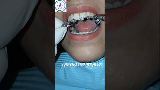 Fixed braces removal dentist orthodontics dentalbraces tooth islamabad rawalpindi [upl. by Consuela]