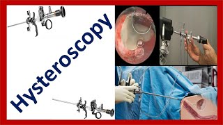 Hysteroscopy Procedure Indications Contraindications and Complications [upl. by Akciret169]