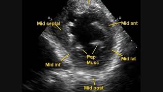 Regional Wall Motion Abnormalities Echocardiography [upl. by Bachman]