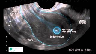 INSTITUT MARQUÈS  I movimenti dellutero favoriscono limpianto dellembrione [upl. by Remy434]