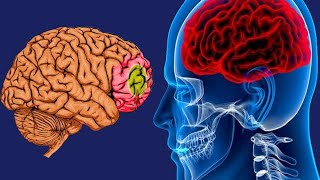 Brain Hypoxia Causes And Symptoms [upl. by Silvestro]