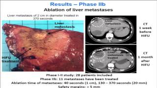 Melodelima  Clinical experience of intraoperative HIFU in colorectal liver mets patients 2016 [upl. by Brennen]