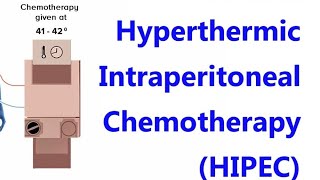 HYPERTHERMIC INTRAPERITONEAL CHEMOTHERAPY HIPEC For Mrcog part3 CaseDiscussionsMRCOGDrShabana [upl. by Shieh]