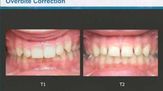 Dr Clark Colville  Class II Correction with Invisalign and the Carriere Distalizer [upl. by Guinevere]