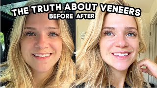 What They Dont Tell You About Getting Veneers Pain Cost Is It Worth it [upl. by Avra]