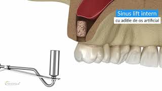 Implantologie  Chirurgie Neoclinique  Sinus lift intern [upl. by Marjy]