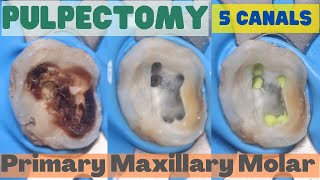 Pulpectomy ⚪️ PRIMARY MAXILLARY MOLAR 🟡 5 Canals 🔵 step by step demonstration [upl. by Adnalu]