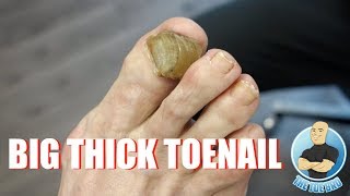 HOW TO TREAT YOUR BIG THICK RAMS HORN TOENAIL  FOOT HEALTH MONTH 2018 14 [upl. by Akimas]