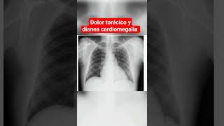 CARDIOMEGALIA DOLOR TORÁCICO Y DISNEA [upl. by Onek4]