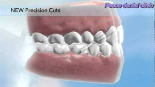 Invisalign Precision cuts [upl. by Ibmat49]