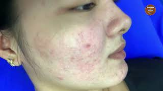 Our client before get Acne Treatment Service [upl. by Hasen]