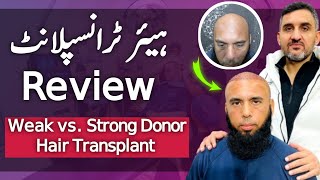 Hair Transplant Honest Review Weak vs Strong Donor Hair Transplant [upl. by Abigail]