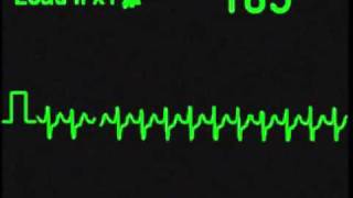 Supraventricular Tachycardia  SVT  ECG Simulator  Arrhythmia Simulator [upl. by Us231]