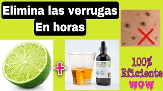 Cómo eliminar VERRUGAS en pocas horas con aceite de MORINGA 100 Eficaz [upl. by Asserat]