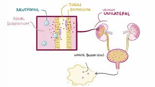 Acute Pyelonephritis  Renal Pathology  Osmosis [upl. by Mike]