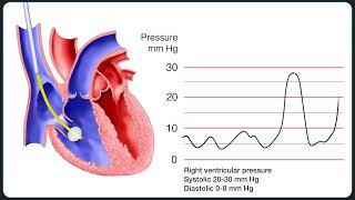 Insertion of a Pulmonary Artery SwanGanz Catheter [upl. by Dnaleel]