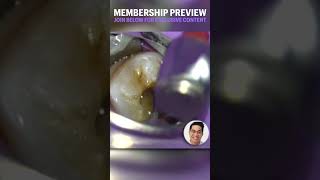 Molar Endodontics Voiceover Preview [upl. by Aihsek663]