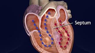 Hypertrophic Obstructive Cardiomyopathy Animation  Treatment Procedure for HOCM Video [upl. by Lauri409]