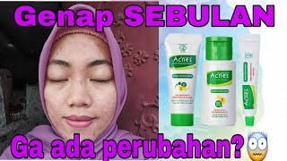 SEBULAN PAKAI ACNES INI KONDISI MUKA AKU [upl. by Eicrad]