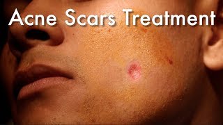 Dermabrasion For Acne Scars [upl. by Witkin451]