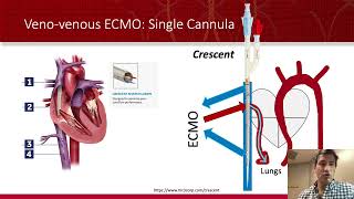 ECMO Cannulation Calamaties [upl. by Yim]