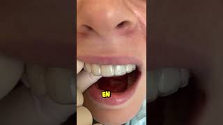 un implante dental es mejor que un diente natural dientes dentista tips parati viral fyp [upl. by Laurentium]