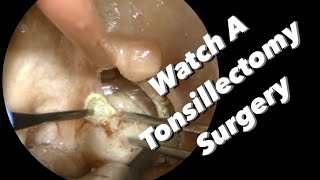 Tonsillectomy Surgery  actual footage [upl. by Nnyltak]