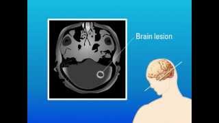 Extrapulmonary Aspergillosis – Type of Fungal Infection [upl. by Ettesyl]