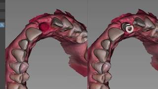 Capturing implant scan Carestream Dental CS 3600 Part I  temp abutment emergence profile [upl. by Inverson]