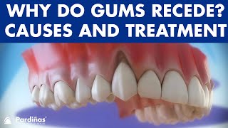 Gum recession  Treatment of gingival retraction © [upl. by Colfin]