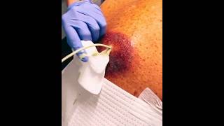 Pimple popping compilation 2024 new acnescars [upl. by Fidellas]