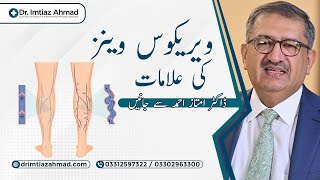 Causes of Varicose Veins  Dr Imtiaz Ahmad [upl. by Anirad148]